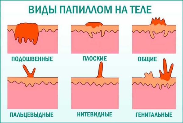 Папилломы под мышками. Причины и лечение, как избавиться