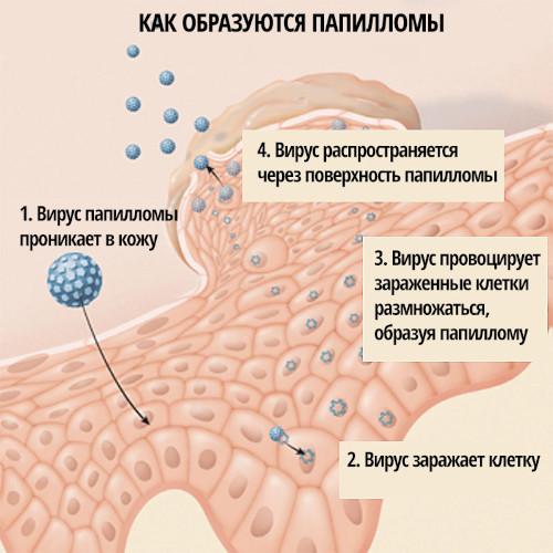 Папилломы под мышками. Причины и лечение, как избавиться