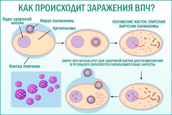 Папилломы под мышками. Причины и лечение, как избавиться